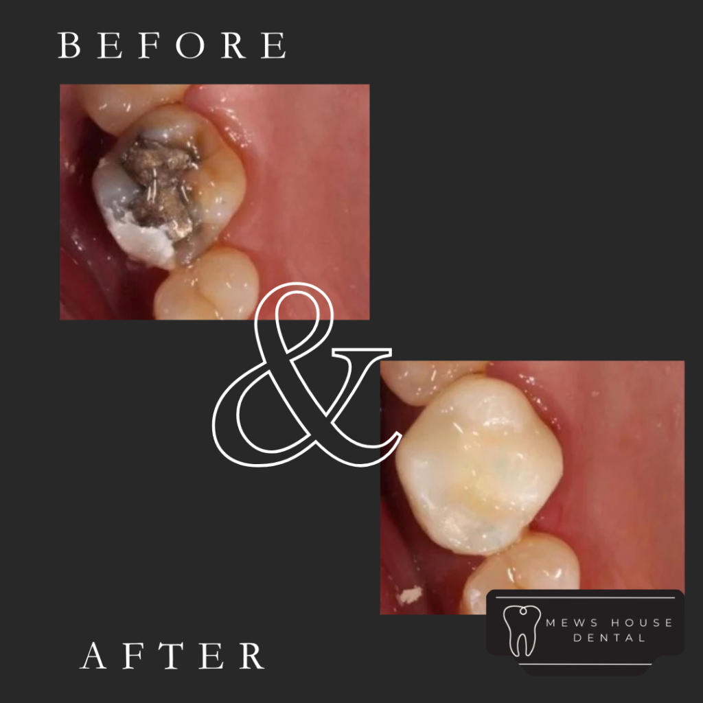 Composite fillings at Mews House Dental