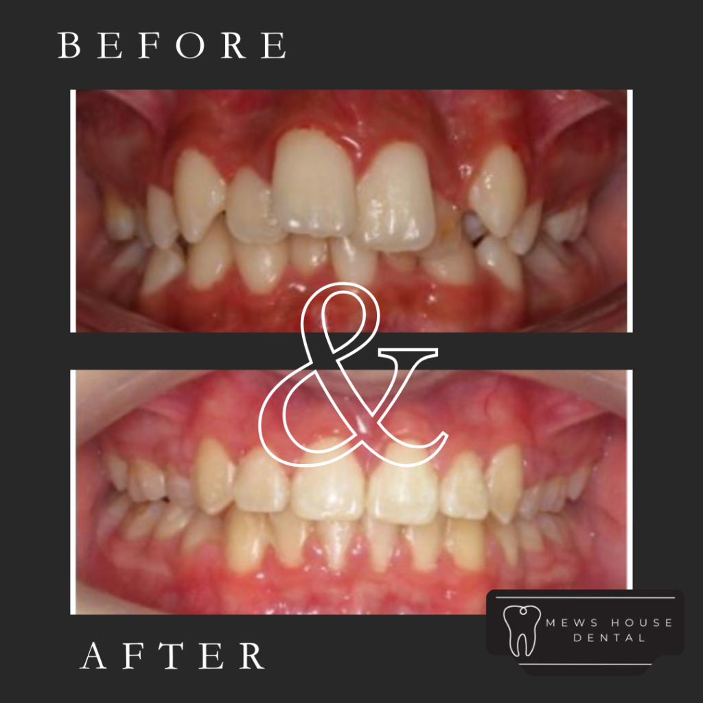 Fixed braces before and after