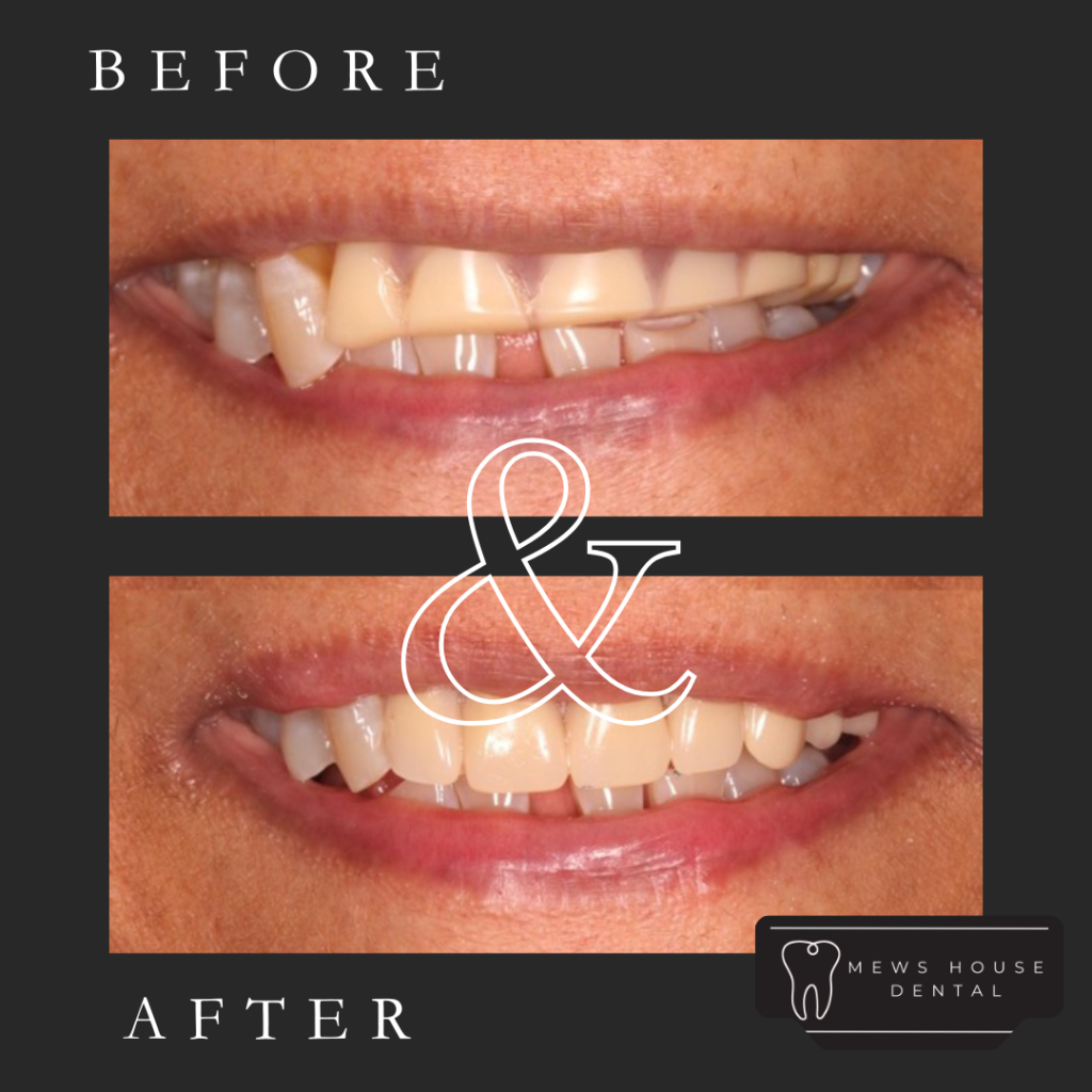 Denture Transformation with Dr Ajay Patel