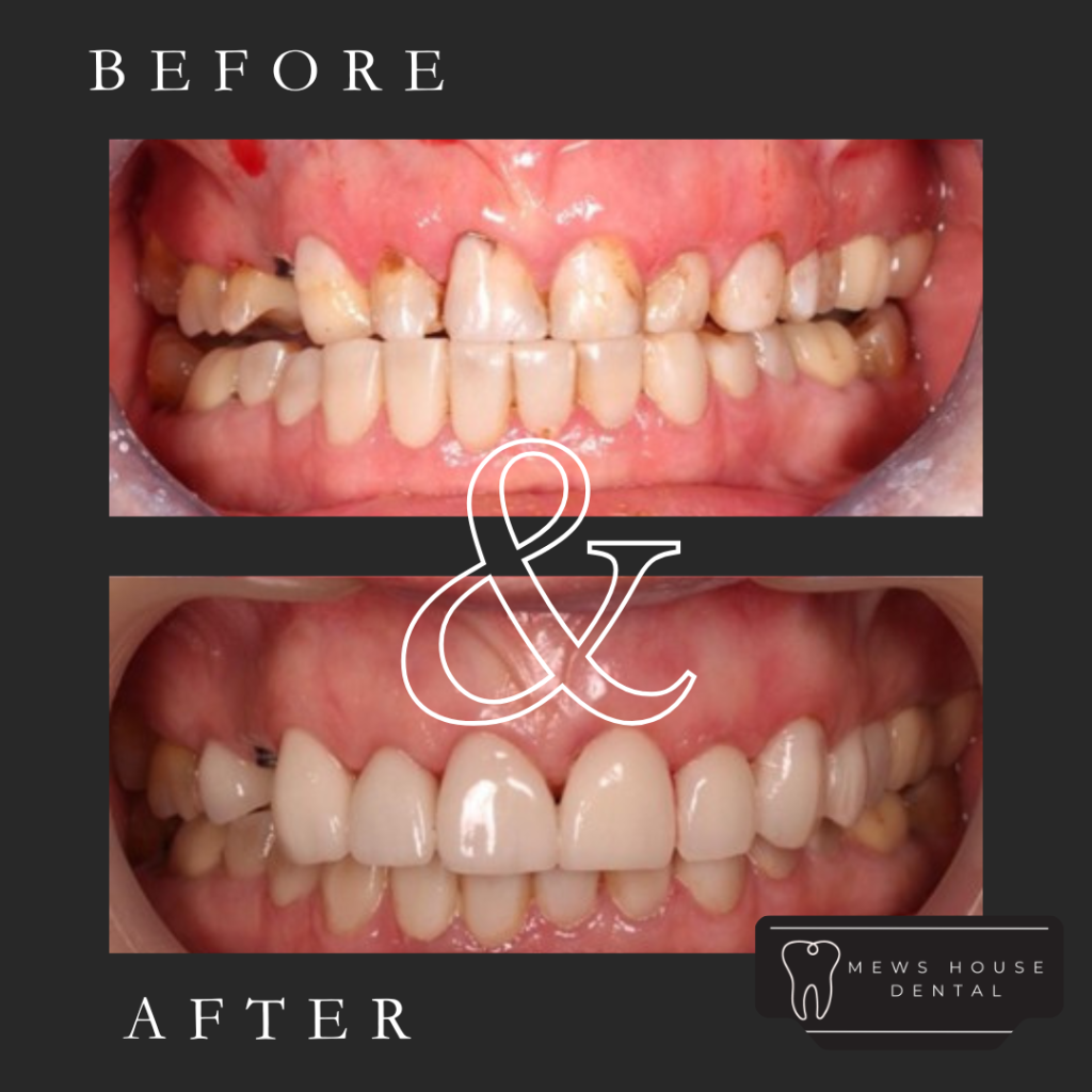 Dr Patel veneer makeover
