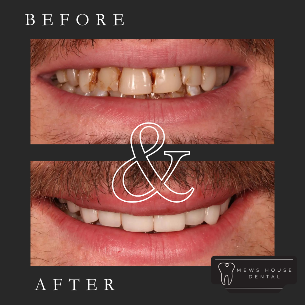 Veneers before and after with Dr Ajay Patel
