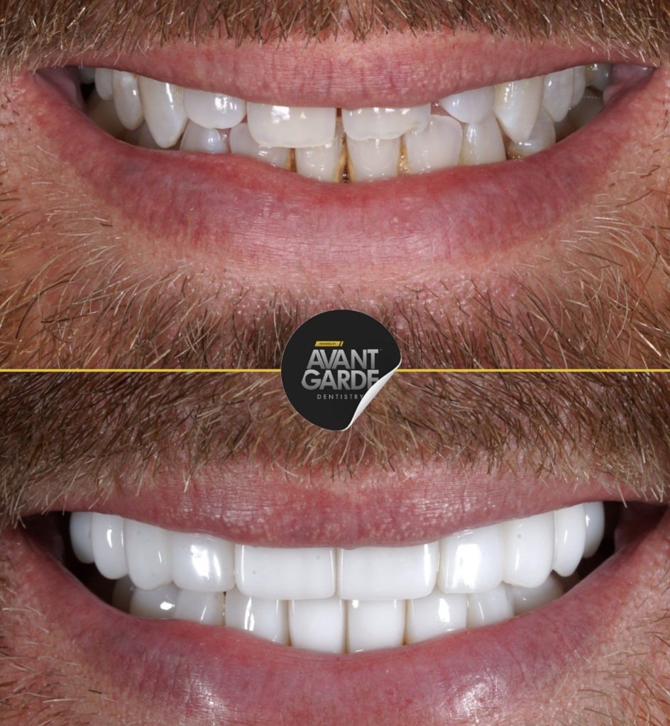 3d veneers at Mews House Dental