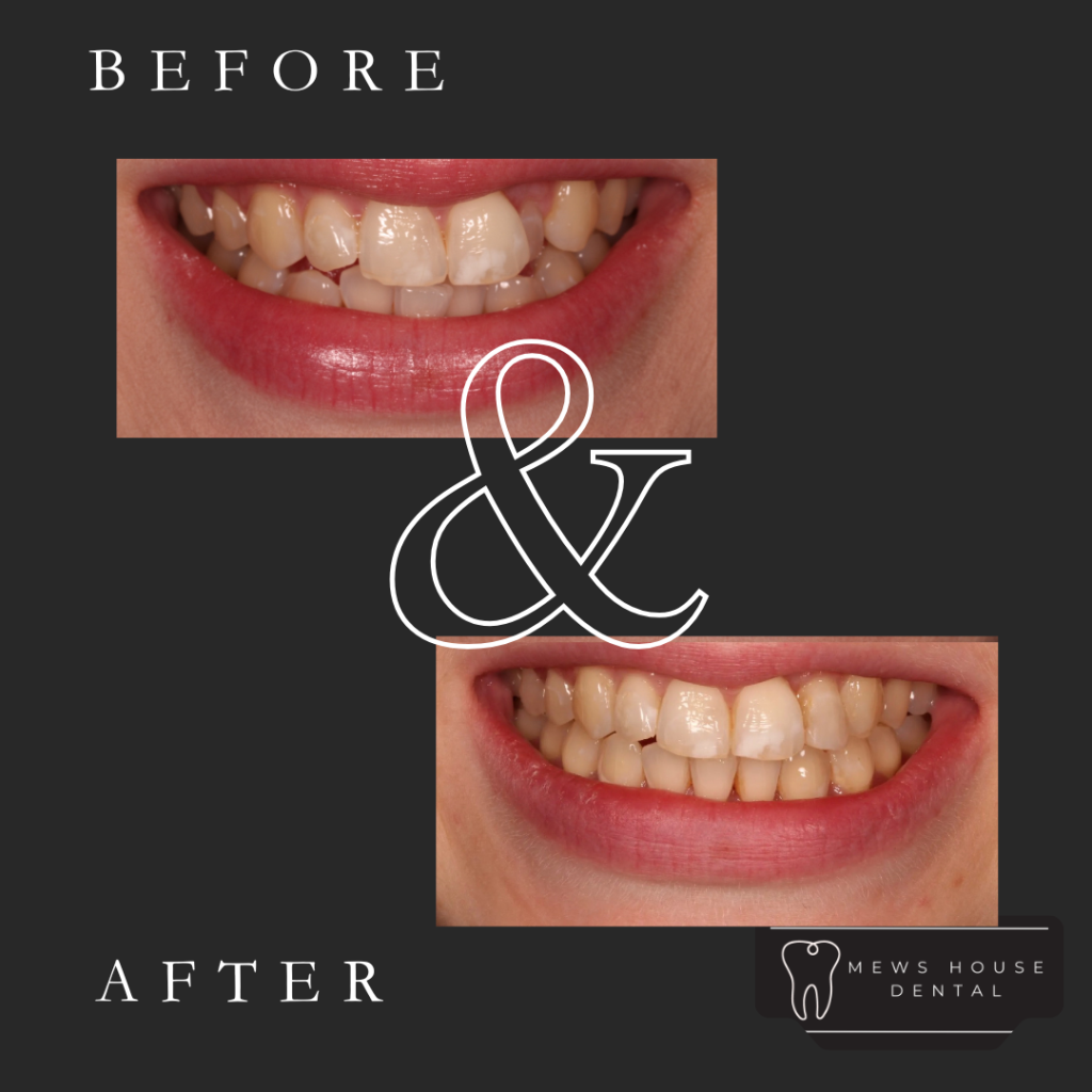 Affordable Removable aligners in Baldock and Royston