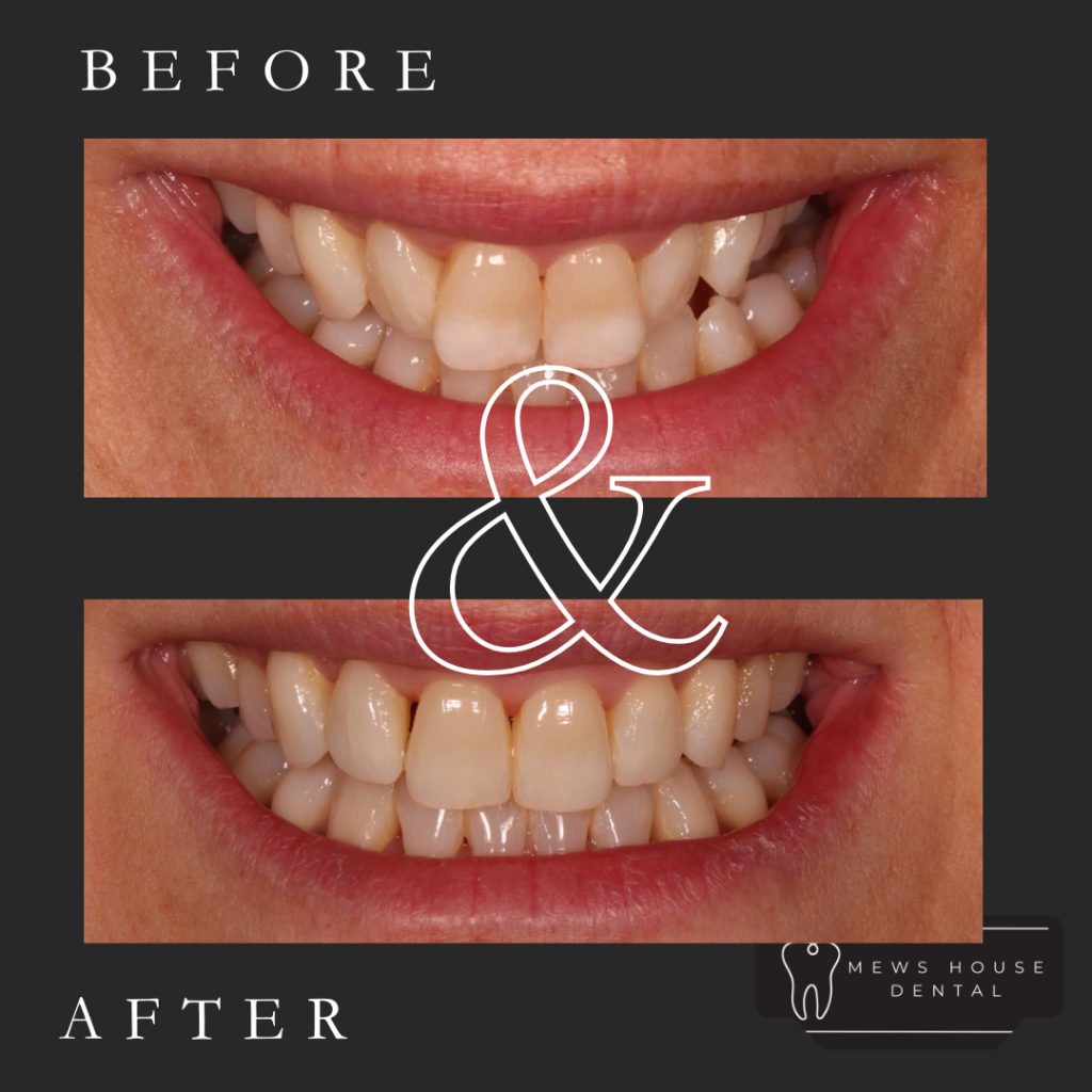 Suresmile removable aligners at Mews House Dental