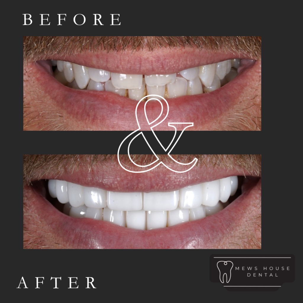 3d veneers at mews house dental